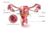 Ovarian Endometriozis Kısırlık Sebebi Midir?
