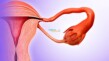 Üreme Organlarında Anormallikler Kadınlarda Yapısal Sorunlar